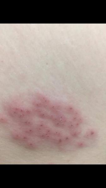 Čo sú toto za vyrážky?