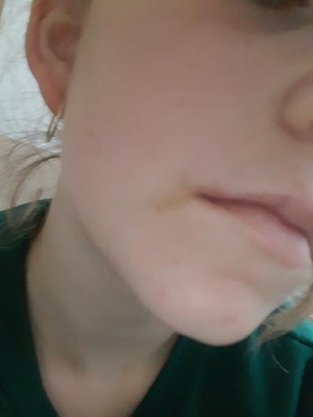 Ako sa zbaviť fľaku pri kútiku úst?