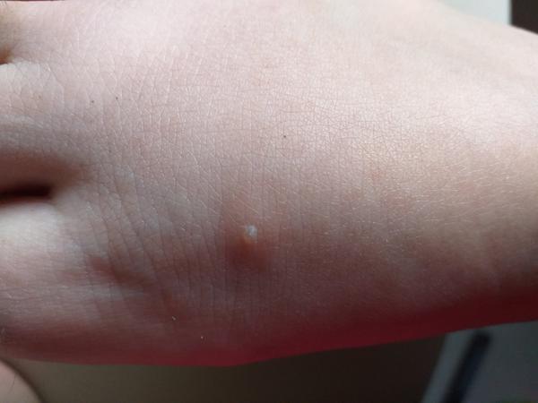 Od čoho mám štípanec s pľuzgierikom?