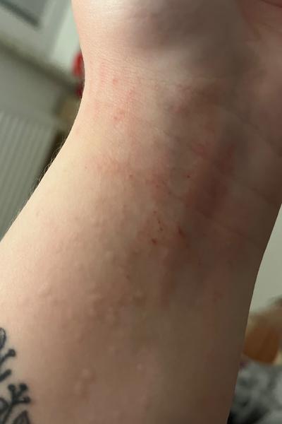 Čo znamená červené miesto na ruke?