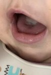 Už po 8.dni používania gélu bolo vidieť, že biely povlak na jazyku sa zmenšuje.