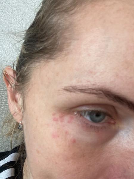 Pomôže čínska medicína na vyrážky pod očami?