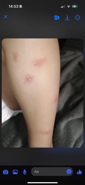 Výražky u 3-ročného dieťaťa