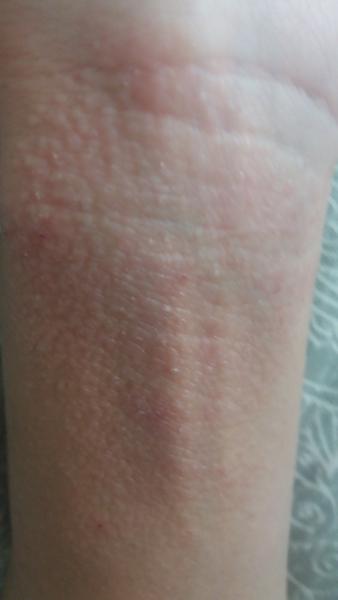 Je to ekzém na zápästí?