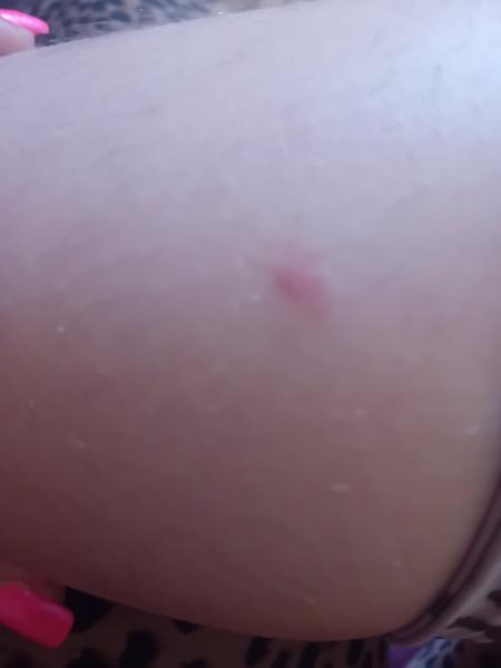 Čo ma poštípalo na obidvoch nohách?