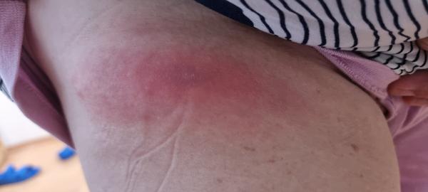 Štípanec a zhoršenie stavu: Ako postupovať?