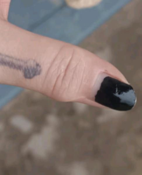 Problém so zápalom palca: Aké sú ďalšie možnosti liečby?