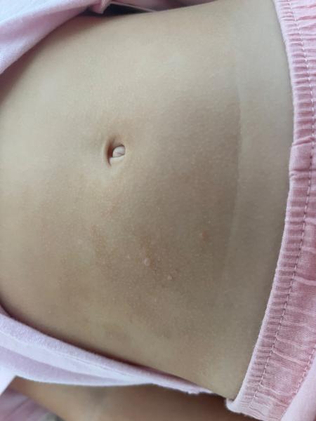 Vyrážky u 3-ročného dieťaťa