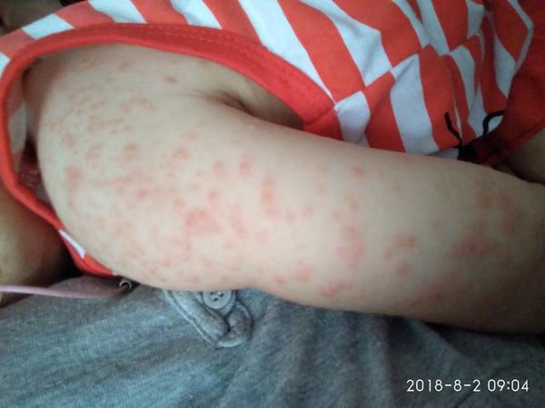 Gianotti Croatia syndróm