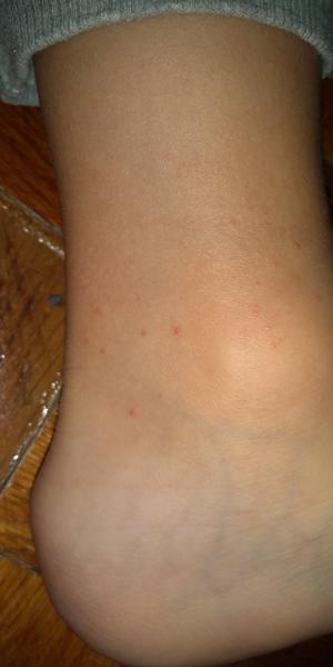 Vyrážky 4-ročného týždeň po chorobe, čo to môže byť?