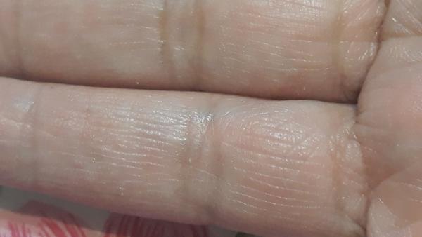 Pribudli mi čiary na prstoch na vnútornej strane