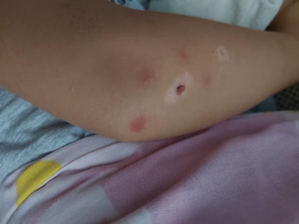 Od čoho by mohli byť tieto štípance?