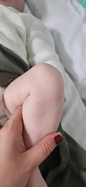 Čo spôsobuje modriny u trojmesačného dieťaťa?