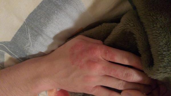 Ako sa lieči reakcia na chlad?