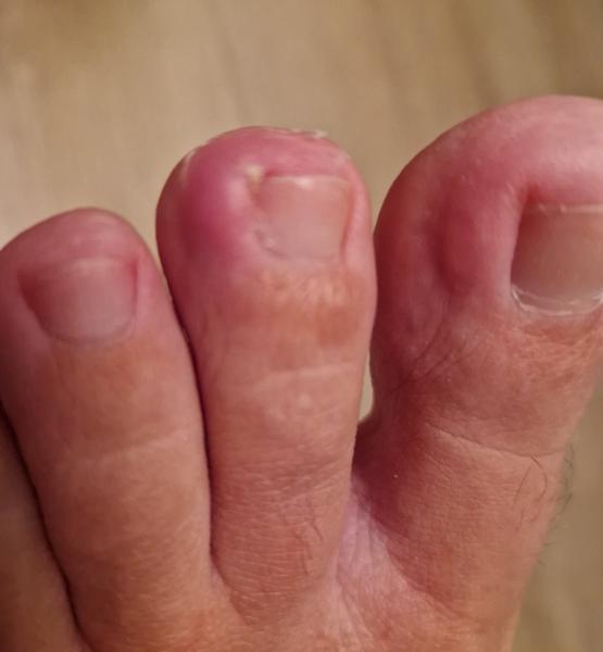 Prečo sa mi po pôrode začali opakovať zápaly na prstoch nôh?