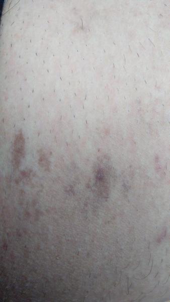 Fľaky na koži u muža - čo to môže byť?