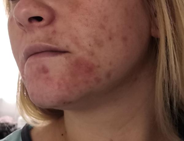 Ku koncu tehotenstva sa mi zhoršilo akné a urobila sa mi lišaj. Čo mi odporúčate?