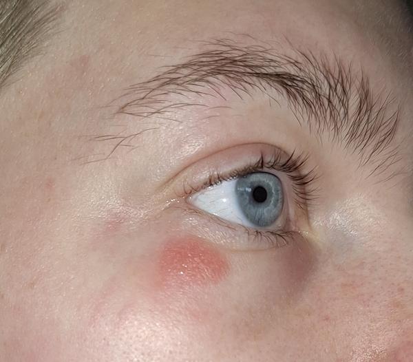 Ako liečiť kožnú reakciu pod okom?