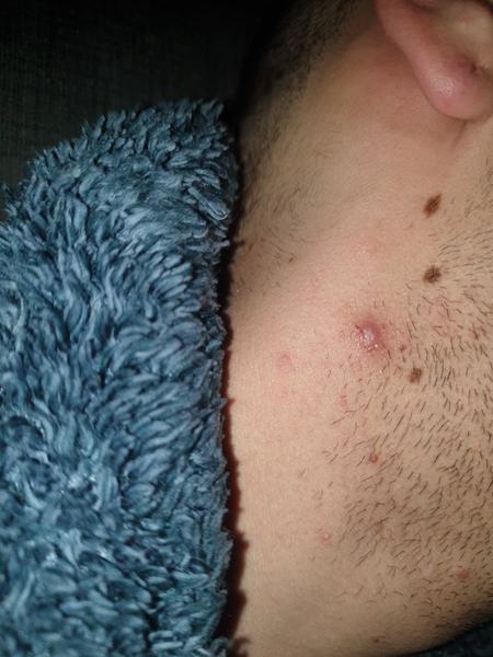 Čo mi pomôže na vredy?