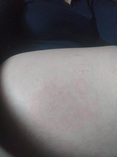 Čo vám pomohlo na žihľavku?