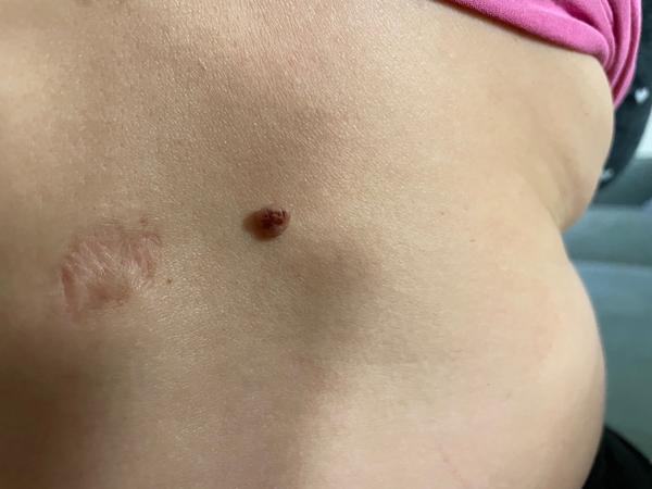 Je možné vybrať znamienko na chrbte aj počas tehotenstva?