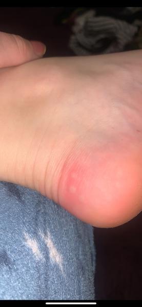 Je toto štípanec od ploštíc?