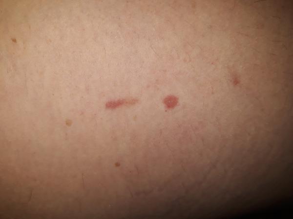 Vyrážky na nohe sa mi akokeby predlžujú