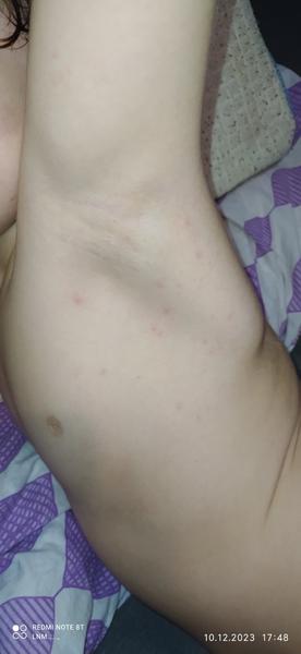 Čo spôsobuje výsev vyrážok?