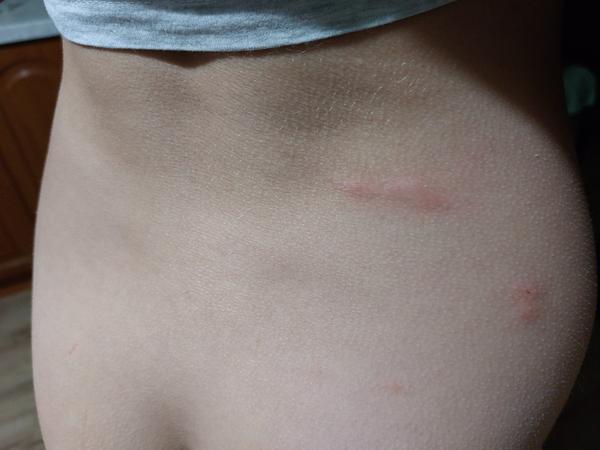 Znamenajú fľaky na tele alergiu?