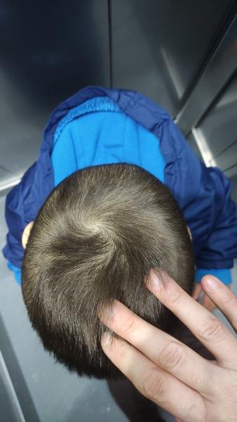 Je v poriadku takáto mierna asymetria lebky u skoro 2-ročného dieťaťa?