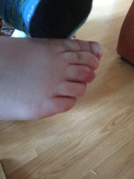 Ako liečiť zapálený prst?