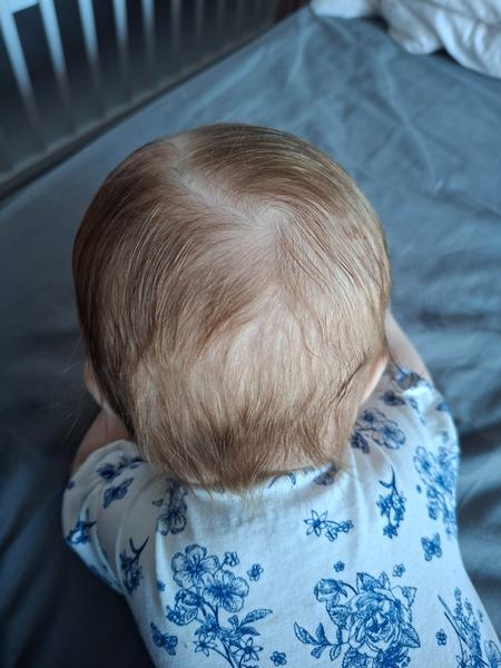 Skúsenosti so zlezenou hlavičkou u bábätka