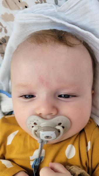 Sú v poriadku viditeľné žilky na spánkoch a nose u bábätka?