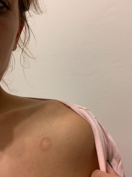 Vyrážky pri kľúčnej kosti, čo to môže byt?