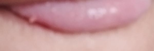 Mám výrastok na jazyku. Môže to byť rakovina?