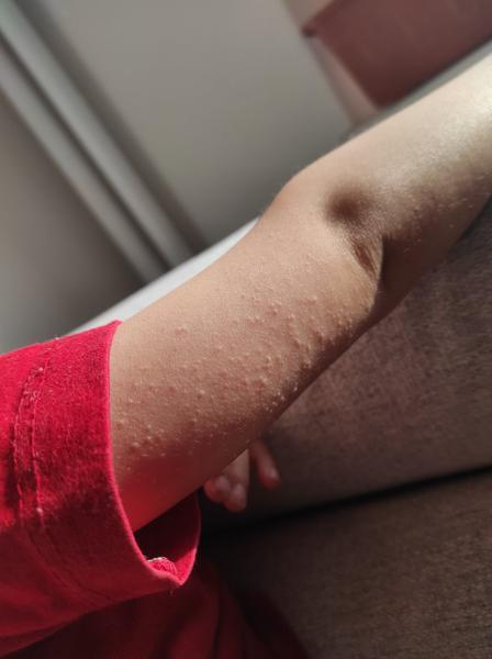 Sú vyrážky na pokožke ruky prirodzené?