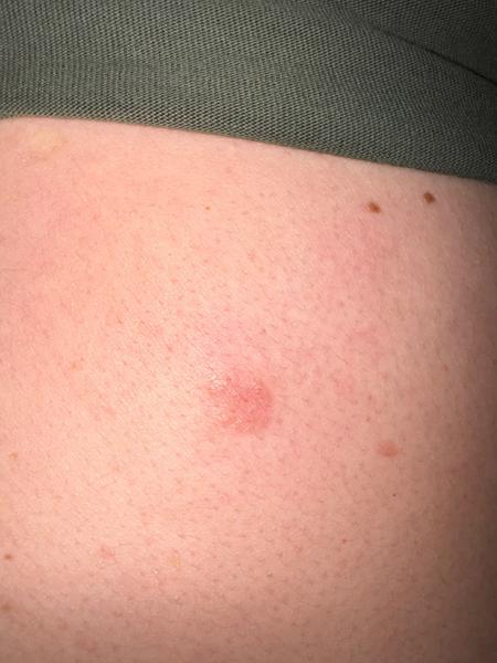 Čo môže spôsobovať vyrážku na chrbte?