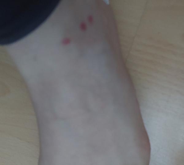 Aké sú to vyrážky?