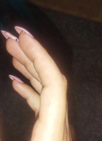 Prečo sa objavili bolestivé červené bodky na prste?