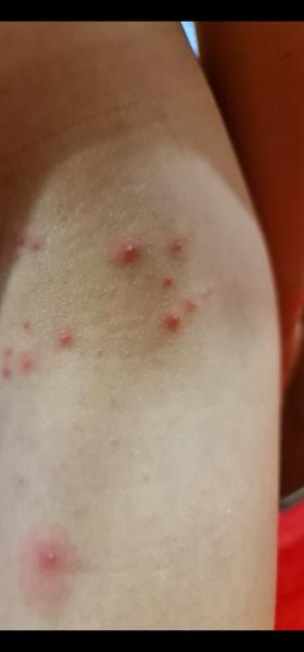 Vyrážky u 8-ročného na bedrách, stehnách, zadočku, na spodnej strane ramien