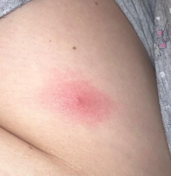 Z čoho sa mi na nohe vytvoril takýto červený fľak?