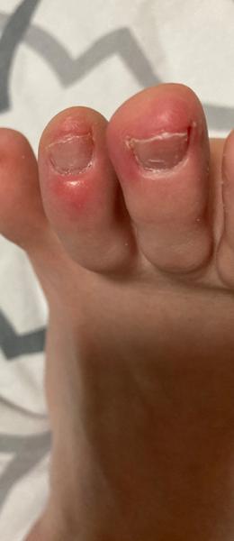 Sú to na prstoch mojich nôh kostné výrastky?