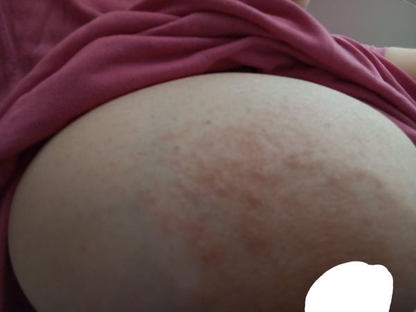 Čo pomôže na začervenané bradavky?