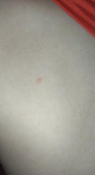 Vyzerá to na kiahne u môjho syna?