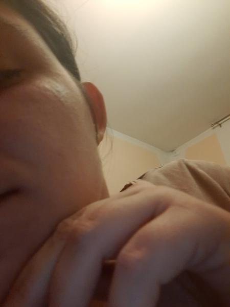 Ako riešiť svrbiace vyrážky na tvári v tehotenstve?