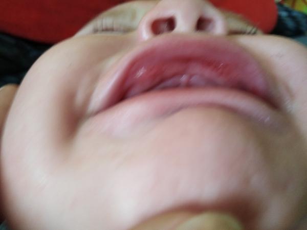 Čo na krvavú peru u 6-mesačného?