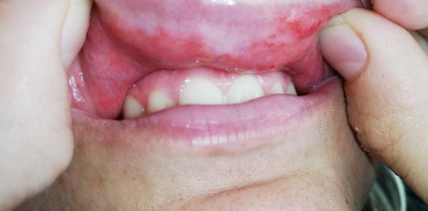 Aký zápal to mám v ústnej dutine?
