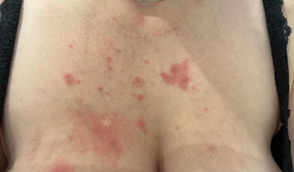 Ráno som sa zobudila s ekzémom na hrudi