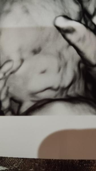 Skúsenosti s rázštepom pery u detí v tehotenstve