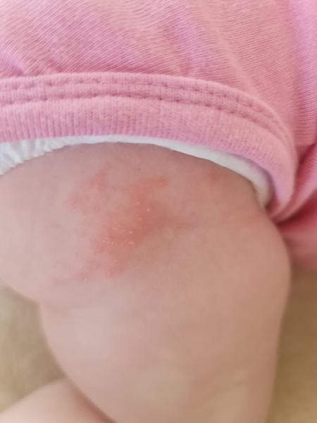 Červené fľaky a vyrážky: Čo to môže byť?